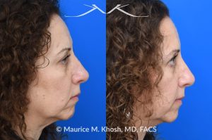 Photo of a patient before and after a procedure. Nose fracture, dorsal widening and deviaiton to the left side. - photo before and after repair.