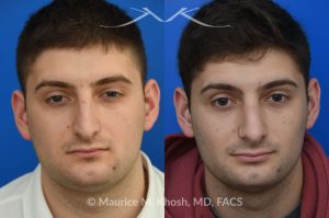 Photo of a patient before and after a procedure. Rhinoplasty - This patient's main complaint was bilateral severe nasal obstruction. His secondary concern was the dorsal hump and droopy nasal tip. We used an open rhinoplasty approach to straighten his deviated septum, lower the dorsal hump and place bilateral spreader grafts to widen the internal nasal valve to enhance his breathing. The nasal tip was reduced in size and rotated to achieve the desired tip position.