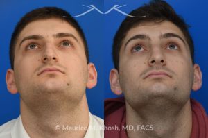 Photo of a patient before and after a procedure. Rhinoplasty - This patient's main complaint was bilateral severe nasal obstruction. His secondary concern was the dorsal hump and droopy nasal tip. We used an open rhinoplasty approach to straighten his deviated septum, lower the dorsal hump and place bilateral spreader grafts to widen the internal nasal valve to enhance his breathing. The nasal tip was reduced in size and rotated to achieve the desired tip position.