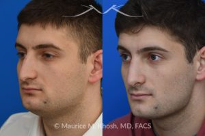 Photo of a patient before and after a procedure. Rhinoplasty - This patient's main complaint was bilateral severe nasal obstruction. His secondary concern was the dorsal hump and droopy nasal tip. We used an open rhinoplasty approach to straighten his deviated septum, lower the dorsal hump and place bilateral spreader grafts to widen the internal nasal valve to enhance his breathing. The nasal tip was reduced in size and rotated to achieve the desired tip position.