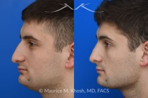 Photo of a patient before and after a procedure. Rhinoplasty - This patient's main complaint was bilateral severe nasal obstruction. His secondary concern was the dorsal hump and droopy nasal tip. We used an open rhinoplasty approach to straighten his deviated septum, lower the dorsal hump and place bilateral spreader grafts to widen the internal nasal valve to enhance his breathing. The nasal tip was reduced in size and rotated to achieve the desired tip position.