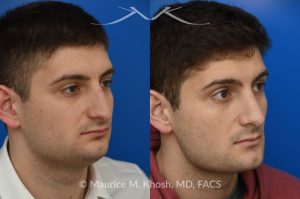 Photo of a patient before and after a procedure. Rhinoplasty - This patient's main complaint was bilateral severe nasal obstruction. His secondary concern was the dorsal hump and droopy nasal tip. We used an open rhinoplasty approach to straighten his deviated septum, lower the dorsal hump and place bilateral spreader grafts to widen the internal nasal valve to enhance his breathing. The nasal tip was reduced in size and rotated to achieve the desired tip position.