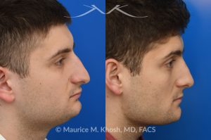 Photo of a patient before and after a procedure. Rhinoplasty - This patient's main complaint was bilateral severe nasal obstruction. His secondary concern was the dorsal hump and droopy nasal tip. We used an open rhinoplasty approach to straighten his deviated septum, lower the dorsal hump and place bilateral spreader grafts to widen the internal nasal valve to enhance his breathing. The nasal tip was reduced in size and rotated to achieve the desired tip position.