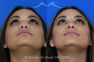 Photo of a patient before and after a procedure. Saddle Nose - This lovely patient had developed saddle collapse of the nose, over-rotation of the nasal tip, and severe nasal obstruction, associated with a septum perforation. In the operating room, a segment of her rib was used to create cartilage grafts to augment the dorsum, and support the nasal tip. A shield graft was fashioned to enhance her nasal tip. Alloderm graft was applied above the dorsal cartilage graft, under the skin. Internal nasal scar tissue was released to further improve breathing. 