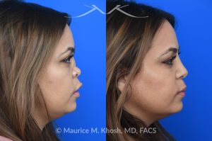 Photo of a patient before and after a procedure. Saddle Nose - This lovely patient had developed saddle collapse of the nose, over-rotation of the nasal tip, and severe nasal obstruction, associated with a septum perforation. In the operating room, a segment of her rib was used to create cartilage grafts to augment the dorsum, and support the nasal tip. A shield graft was fashioned to enhance her nasal tip. Alloderm graft was applied above the dorsal cartilage graft, under the skin. Internal nasal scar tissue was released to further improve breathing. 