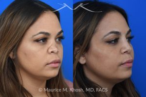 Photo of a patient before and after a procedure. Saddle Nose - This lovely patient had developed saddle collapse of the nose, over-rotation of the nasal tip, and severe nasal obstruction, associated with a septum perforation. In the operating room, a segment of her rib was used to create cartilage grafts to augment the dorsum, and support the nasal tip. A shield graft was fashioned to enhance her nasal tip. Alloderm graft was applied above the dorsal cartilage graft, under the skin. Internal nasal scar tissue was released to further improve breathing. 