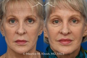 Photo of a patient before and after a procedure. Lip Lift