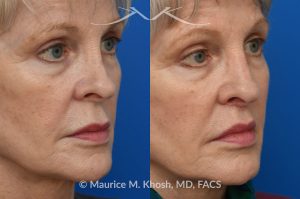 Photo of a patient before and after a procedure. Lip Lift