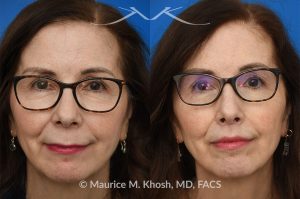 Photo of a patient before and after a procedure. Lip Lift - before and after photos.