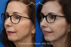 Photo of a patient before and after a procedure. Lip Lift - before and after photos.