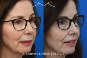 Photo of a patient before and after a procedure. Lip Enhancement Photo Gallery