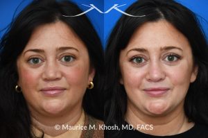 Photo of a patient before and after a procedure. Revision rhinoplasty utilizing rib cartilage - Revision rhinoplasty utilizing the patient's own rib cartilage to address collapsing cartilaginous nasal bridge, obstructed breathing, and nasal tip asymmetry. Surgical maneuvers including bilateral spreader grafts, alar strut grafts, columellar strut graft,and a shield graft were used to enhance nasal breathing and aesthetics. The post operative pictures were taken two months after surgery. Further improvement is expected upto eighteen months post op.