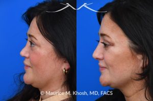 Photo of a patient before and after a procedure. Revision rhinoplasty utilizing rib cartilage - Revision rhinoplasty utilizing the patient's own rib cartilage to address collapsing cartilaginous nasal bridge, obstructed breathing, and nasal tip asymmetry. Surgical maneuvers including bilateral spreader grafts, alar strut grafts, columellar strut graft,and a shield graft were used to enhance nasal breathing and aesthetics. The post operative pictures were taken two months after surgery. Further improvement is expected upto eighteen months post op.