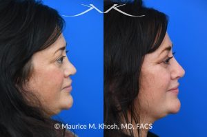 Photo of a patient before and after a procedure. Revision rhinoplasty utilizing rib cartilage - Revision rhinoplasty utilizing the patient's own rib cartilage to address collapsing cartilaginous nasal bridge, obstructed breathing, and nasal tip asymmetry. Surgical maneuvers including bilateral spreader grafts, alar strut grafts, columellar strut graft,and a shield graft were used to enhance nasal breathing and aesthetics. The post operative pictures were taken two months after surgery. Further improvement is expected upto eighteen months post op.