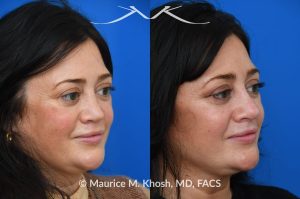 Photo of a patient before and after a procedure. Revision rhinoplasty utilizing rib cartilage - Revision rhinoplasty utilizing the patient's own rib cartilage to address collapsing cartilaginous nasal bridge, obstructed breathing, and nasal tip asymmetry. Surgical maneuvers including bilateral spreader grafts, alar strut grafts, columellar strut graft,and a shield graft were used to enhance nasal breathing and aesthetics. The post operative pictures were taken two months after surgery. Further improvement is expected upto eighteen months post op.