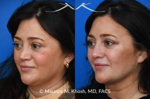 Photo of a patient before and after a procedure. Revision rhinoplasty utilizing rib cartilage - Revision rhinoplasty utilizing the patient's own rib cartilage to address collapsing cartilaginous nasal bridge, obstructed breathing, and nasal tip asymmetry. Surgical maneuvers including bilateral spreader grafts, alar strut grafts, columellar strut graft,and a shield graft were used to enhance nasal breathing and aesthetics. The post operative pictures were taken two months after surgery. Further improvement is expected upto eighteen months post op.