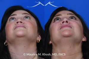 Photo of a patient before and after a procedure. Revision rhinoplasty utilizing rib cartilage - Revision rhinoplasty utilizing the patient's own rib cartilage to address collapsing cartilaginous nasal bridge, obstructed breathing, and nasal tip asymmetry. Surgical maneuvers including bilateral spreader grafts, alar strut grafts, columellar strut graft,and a shield graft were used to enhance nasal breathing and aesthetics. The post operative pictures were taken two months after surgery. Further improvement is expected upto eighteen months post op.