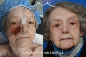 Photo of a patient before and after a procedure. Mohs skin reconstruction of the cheek - A very large defect on the right medial cheek, resulting from a Mohs procedure, was successfully repaired using a cervico-facial advancement rotation flap. This technique allowed for the restoration of both the aesthetic and functional integrity of the cheek area, resulting in a natural and smooth appearance.