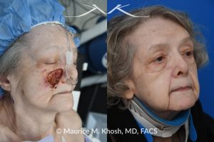 Photo of a patient before and after a procedure. Mohs skin reconstruction of the cheek - A very large defect on the right medial cheek, resulting from a Mohs procedure, was successfully repaired using a cervico-facial advancement rotation flap. This technique allowed for the restoration of both the aesthetic and functional integrity of the cheek area, resulting in a natural and smooth appearance.