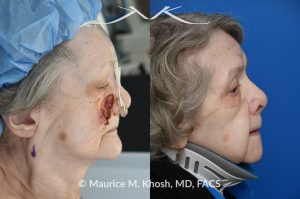 Photo of a patient before and after a procedure. Mohs skin reconstruction of the cheek - A very large defect on the right medial cheek, resulting from a Mohs procedure, was successfully repaired using a cervico-facial advancement rotation flap. This technique allowed for the restoration of both the aesthetic and functional integrity of the cheek area, resulting in a natural and smooth appearance.