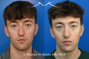 Photo of a patient before and after a procedure. Repair of Left Nasal Valve - This patient suffered a nasal fracture that resulted in the collapse of the left nasal valve. Reconstruction included a spreader graft on the right side and removal of the nasal hump. The surgery improved his breathing, enhanced nasal symmetry, and eliminated the bump on his nasal bridge.