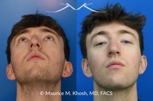 Photo of a patient before and after a procedure. Repair of Left Nasal Valve - This patient suffered a nasal fracture that resulted in the collapse of the left nasal valve. Reconstruction included a spreader graft on the right side and removal of the nasal hump. The surgery improved his breathing, enhanced nasal symmetry, and eliminated the bump on his nasal bridge.