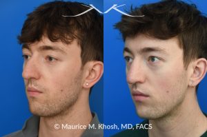 Photo of a patient before and after a procedure. Repair of Left Nasal Valve - This patient suffered a nasal fracture that resulted in the collapse of the left nasal valve. Reconstruction included a spreader graft on the right side and removal of the nasal hump. The surgery improved his breathing, enhanced nasal symmetry, and eliminated the bump on his nasal bridge.