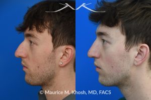 Photo of a patient before and after a procedure. Repair of Left Nasal Valve - This patient suffered a nasal fracture that resulted in the collapse of the left nasal valve. Reconstruction included a spreader graft on the right side and removal of the nasal hump. The surgery improved his breathing, enhanced nasal symmetry, and eliminated the bump on his nasal bridge.