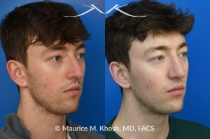 Photo of a patient before and after a procedure. Repair of Left Nasal Valve - This patient suffered a nasal fracture that resulted in the collapse of the left nasal valve. Reconstruction included a spreader graft on the right side and removal of the nasal hump. The surgery improved his breathing, enhanced nasal symmetry, and eliminated the bump on his nasal bridge.