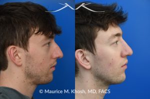 Photo of a patient before and after a procedure. Repair of Left Nasal Valve - This patient suffered a nasal fracture that resulted in the collapse of the left nasal valve. Reconstruction included a spreader graft on the right side and removal of the nasal hump. The surgery improved his breathing, enhanced nasal symmetry, and eliminated the bump on his nasal bridge.