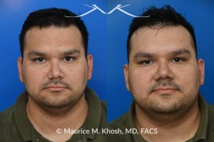 Photo of a patient before and after a procedure. Nasal valve repair - This patient had previously undergone septoplasty to improve his breathing. However, he continued to experience obstruction, especially during sleep or exercise. Nasal valve repair using his own rib cartilage successfully restored his breathing.