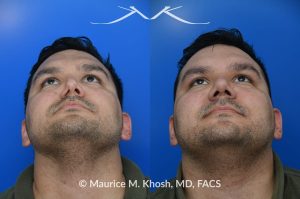 Photo of a patient before and after a procedure. Nasal valve repair - This patient had previously undergone septoplasty to improve his breathing. However, he continued to experience obstruction, especially during sleep or exercise. Nasal valve repair using his own rib cartilage successfully restored his breathing.