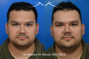 Photo of a patient before and after a procedure. Nasal valve repair - This patient had previously undergone septoplasty to improve his breathing. However, he continued to experience obstruction, especially during sleep or exercise. Nasal valve repair using his own rib cartilage successfully restored his breathing.