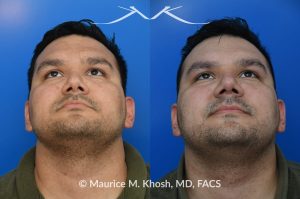 Photo of a patient before and after a procedure. Nasal valve repair - This patient had previously undergone septoplasty to improve his breathing. However, he continued to experience obstruction, especially during sleep or exercise. Nasal valve repair using his own rib cartilage successfully restored his breathing.