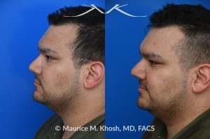 Photo of a patient before and after a procedure. Nasal valve repair - This patient had previously undergone septoplasty to improve his breathing. However, he continued to experience obstruction, especially during sleep or exercise. Nasal valve repair using his own rib cartilage successfully restored his breathing.