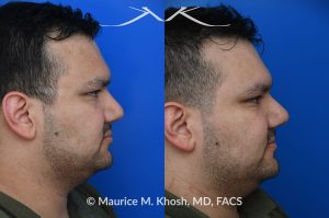 Photo of a patient before and after a procedure. Nasal valve repair - This patient had previously undergone septoplasty to improve his breathing. However, he continued to experience obstruction, especially during sleep or exercise. Nasal valve repair using his own rib cartilage successfully restored his breathing.