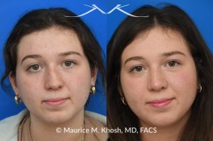 Photo of a patient before and after a procedure. Rhinoplasty for nasal bridge deviation and droopy tip - This young patient had a nasal hump, a deviated nose on the front view, and lacked nasal tip definition. An open rhinoplasty was performed to address all areas of concern. She is extremely happy with her final results.