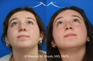 Photo of a patient before and after a procedure. Rhinoplasty for nasal bridge deviation and droopy tip - This young patient had a nasal hump, a deviated nose on the front view, and lacked nasal tip definition. An open rhinoplasty was performed to address all areas of concern. She is extremely happy with her final results.