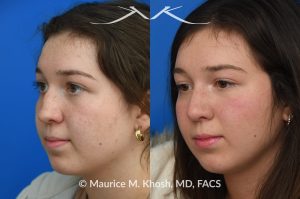 Photo of a patient before and after a procedure. Rhinoplasty for nasal bridge deviation and droopy tip - This young patient had a nasal hump, a deviated nose on the front view, and lacked nasal tip definition. An open rhinoplasty was performed to address all areas of concern. She is extremely happy with her final results.