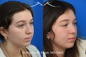 Photo of a patient before and after a procedure. Rhinoplasty for nasal bridge deviation and droopy tip - This young patient had a nasal hump, a deviated nose on the front view, and lacked nasal tip definition. An open rhinoplasty was performed to address all areas of concern. She is extremely happy with her final results.