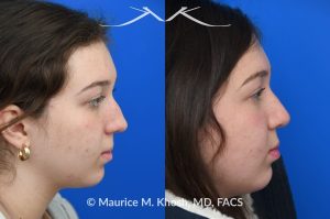 Photo of a patient before and after a procedure. Rhinoplasty for nasal bridge deviation and droopy tip - This young patient had a nasal hump, a deviated nose on the front view, and lacked nasal tip definition. An open rhinoplasty was performed to address all areas of concern. She is extremely happy with her final results.