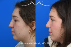 Photo of a patient before and after a procedure. Rhinoplasty for nasal bridge deviation and droopy tip - This young patient had a nasal hump, a deviated nose on the front view, and lacked nasal tip definition. An open rhinoplasty was performed to address all areas of concern. She is extremely happy with her final results.