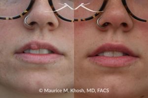 Photo of a patient before and after a procedure. Right Upper Lip Scar Removal - Prior trauma had resulted in a visible mass in the right upper lip. Scar revision of the lip allowed restoration of normal lip contour.