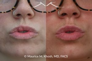 Photo of a patient before and after a procedure. Right Upper Lip Scar Removal - Prior trauma had resulted in a visible mass in the right upper lip. Scar revision of the lip allowed restoration of normal lip contour.