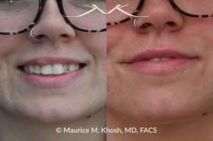 Photo of a patient before and after a procedure. Right Upper Lip Scar Removal - Prior trauma had resulted in a visible mass in the right upper lip. Scar revision of the lip allowed restoration of normal lip contour.