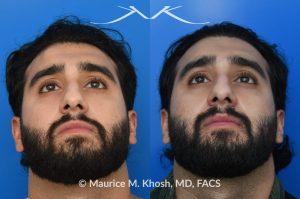 Photo of a patient before and after a procedure. Forehead Osteoma Removal - This large osteoma was successfully removed under local anesthesia using a power drill. The patient is ecstatic about his results. 