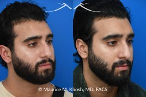 Photo of a patient before and after a procedure. Forehead Osteoma Removal - This large osteoma was successfully removed under local anesthesia using a power drill. The patient is ecstatic about his results. 