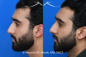 Photo of a patient before and after a procedure. Forehead Osteoma Removal - This large osteoma was successfully removed under local anesthesia using a power drill. The patient is ecstatic about his results. 