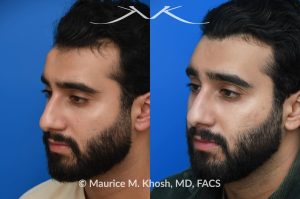 Photo of a patient before and after a procedure. Forehead Osteoma Removal - This large osteoma was successfully removed under local anesthesia using a power drill. The patient is ecstatic about his results. 