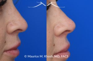 Photo of a patient before and after a procedure. Liquid rhinoplasty - Filler injection into the nasal tip allowed improved rotation of the nasal tip without surgery.